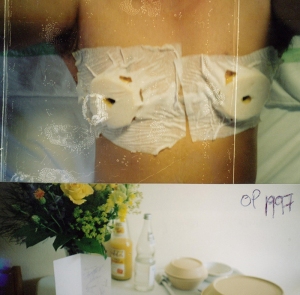 1997 boob operation